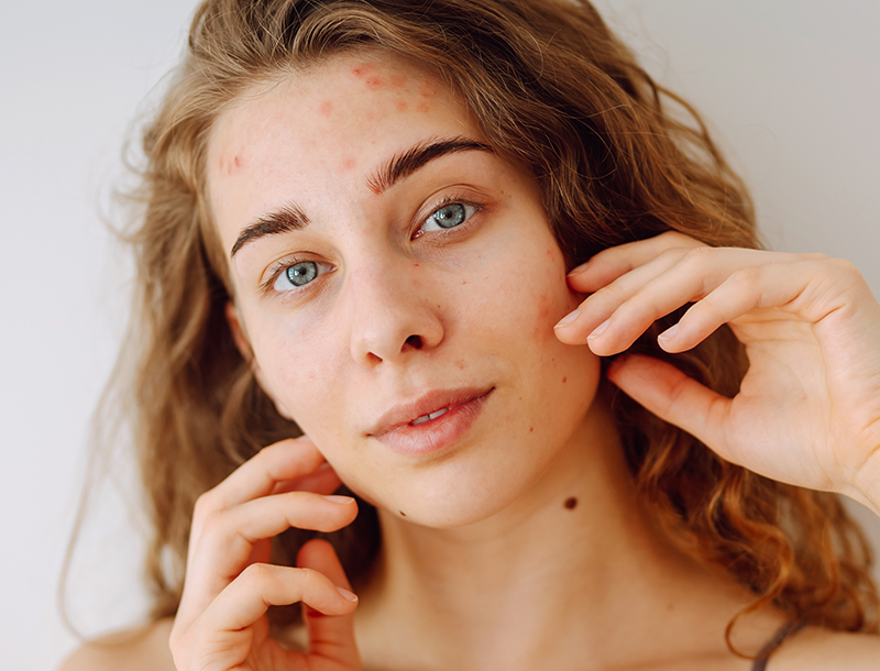 Junge Frau mit sichtbaren Hautunreinheiten und Rötungen im Gesicht blickt in die Kamera.